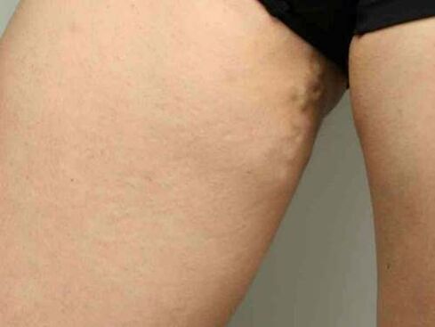 proširene vene zdjelice tijekom trudnoće